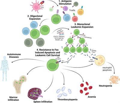 Intersection Between Large Granular Lymphocyte Leukemia and Rheumatoid Arthritis